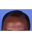 Before Hair Transplant &nbsp;Front